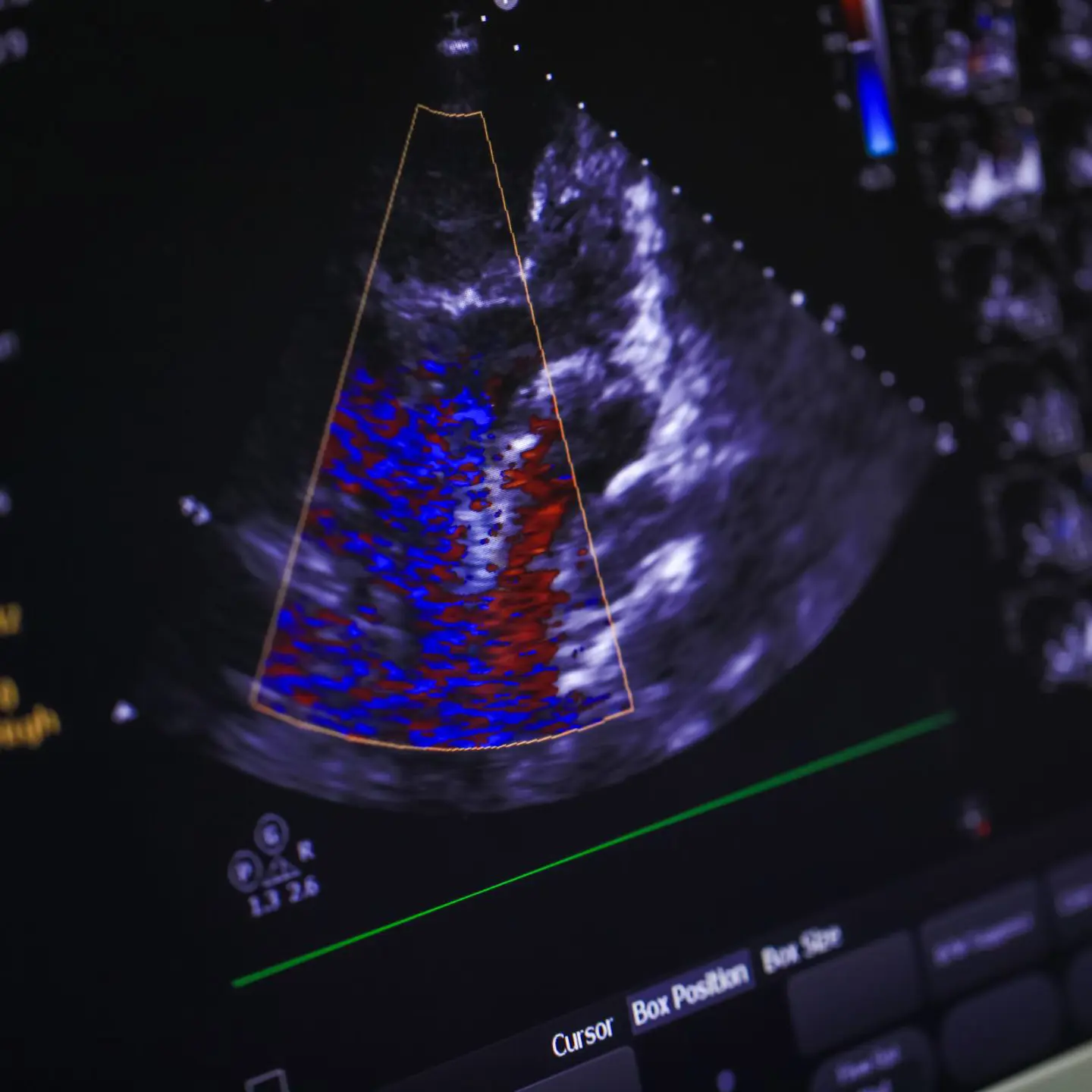 Echocardiogram Soundwaves