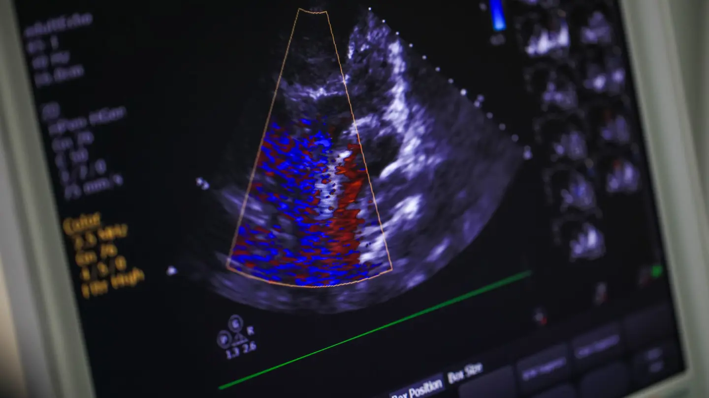 Echocardiogram Soundwaves