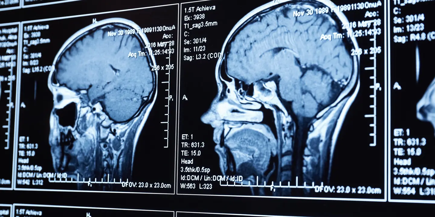 MRI Head Scan