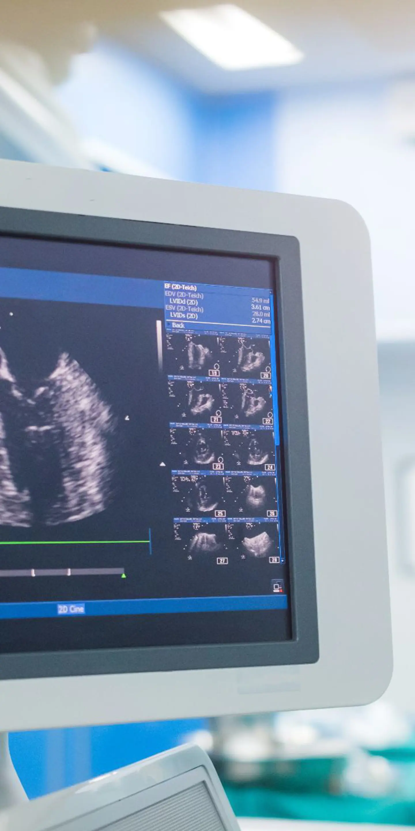 Echo Heart Scan Ultrasound (1)