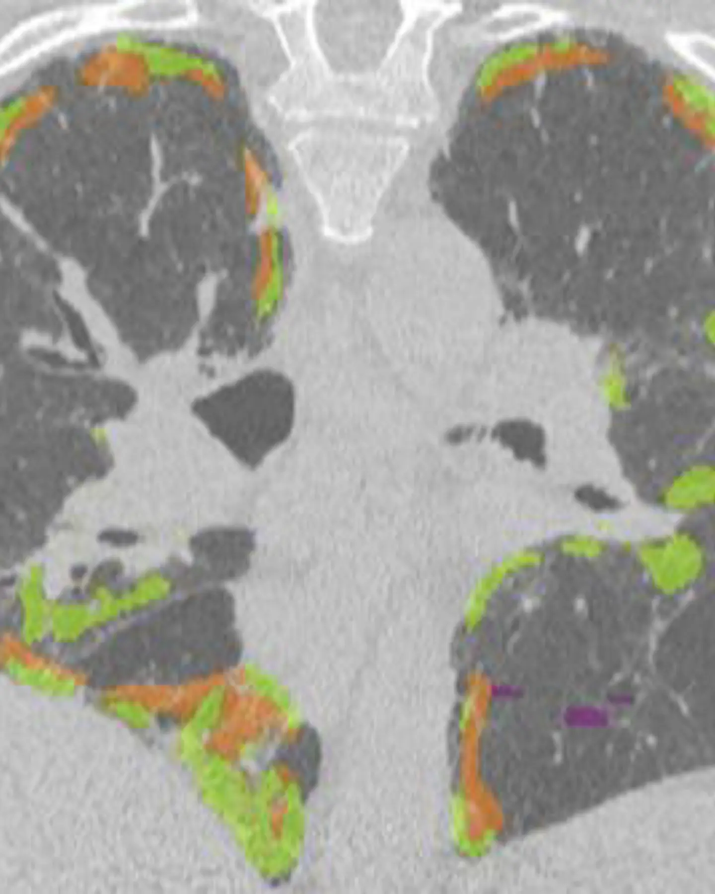 Lung Image