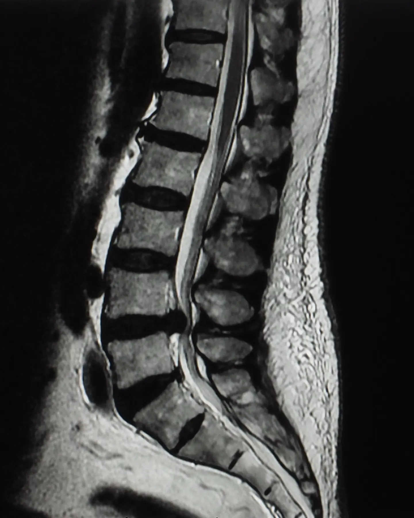 MRI Lumbar Spine L5 S1 Level