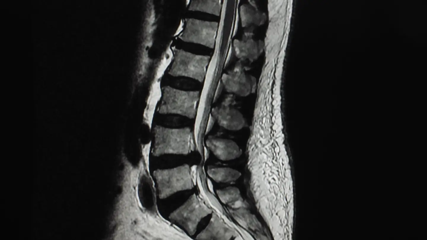 MRI Lumbar Spine L5 S1 Level