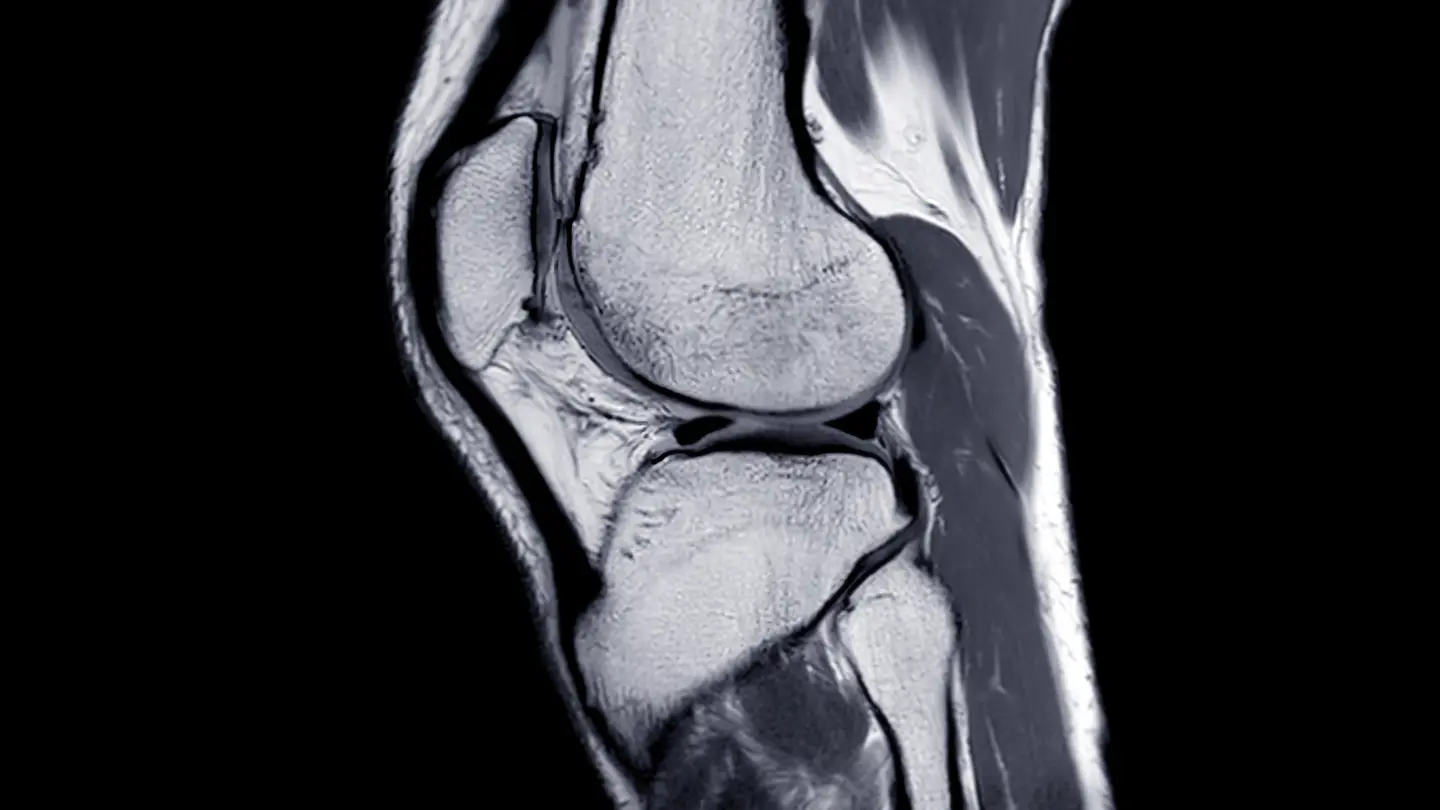 MRI Knee Joint